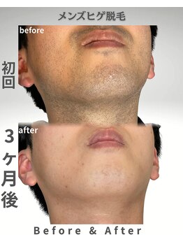 ニチワ 御器所店(NICHIWA)/ヒゲ脱毛