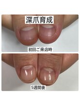 マニュコクーン(ManuCocoon)/爪育成　深爪　巻き爪　大阪市