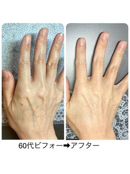 桃の木 吉祥寺店/乾燥にお薦め!補水エステ