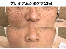 プレジール(plaisir)/シミケアコース