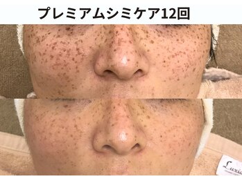 プレジール(plaisir)/シミケアコース