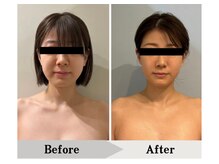 エミット(emit)/脂肪分解施術