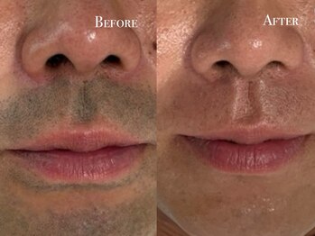 イースト(EAST)/ヒゲ脱毛10回以上