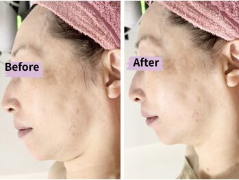 マリア(MALIA)/50代60代フェイスラインたるみ