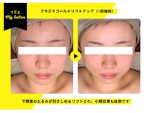 イエス マイサロン(yes My Salon)/プラズマリフトアップ症例