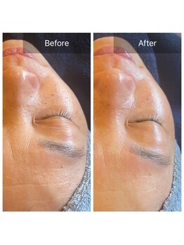 アリス(Alice)/マツヤニWAX BeforeAfter