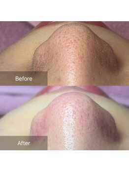 癒える(ielu)/毛穴エクストラクションBA