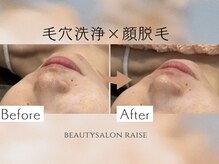 レイズ(RAISE)の雰囲気（紫外線が強くなる前！梅雨のジメジメ前に！徹底毛穴ケア♪）