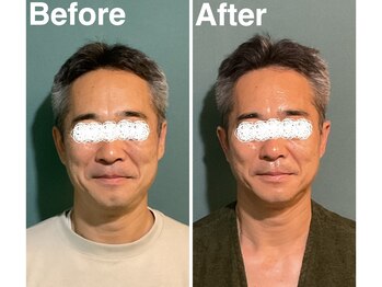 ミエーレ(miele)/Before & After　50代男性