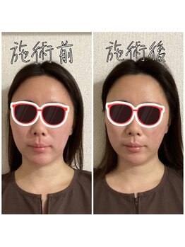 エクステンド鍼灸整体院(extend鍼灸整体院)/施術後 美容鍼