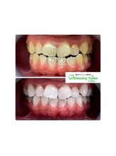 ホワイトニングサロン 名古屋駅店/【ホワイトニング施術例】