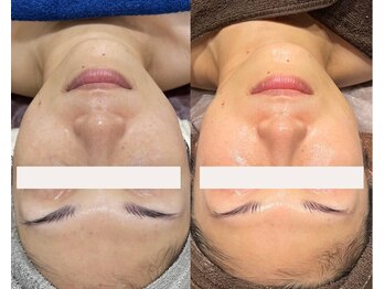 フェイスプラスリフ(FACE+RiF)/くすみ、肌改善