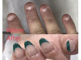 【深爪矯正長さ出しコース】10本