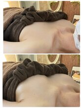 スマイルクルー(SmileClue)/初回ビフォーアフター症例