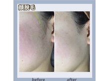 肌悩み解決★顔脱毛×フェイシャルエステ！毛穴詰まり・ニキビ・くすみに洗浄＋ピーリング＋脱毛が効く