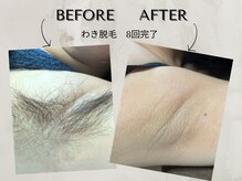 ワンアップ(One-up)/わき脱毛 8回完了 before  after