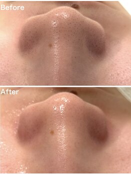 アディクト 中目黒店(ADDICT)/韓国式3D毛穴洗浄