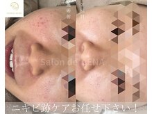 サロンドレナ 名駅店/ハーブピーリング サロンドレナ