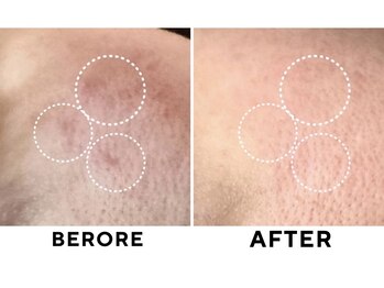 ゼロ(ZERO)/ダクトピール