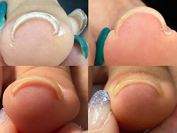 MINIM -JeWeL-【2/1OPEN(予定)】の写真/【巻き爪改善特化】爪のお悩みをケアして見た目も美しく*特殊ジェルで叶えるストレスフリーな美爪へ◎