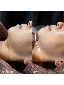 サロンドウルス(salon de ours)の写真/【岐阜市/SNS話題】最新の韓国式脂肪分解★レモンボトルで二重顎/もたつき解消♪速攻小顔モニター￥7700