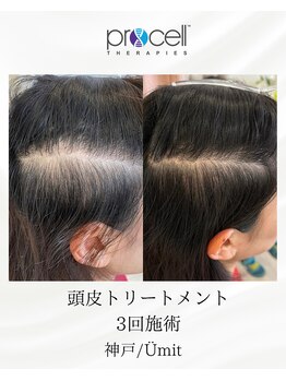 ユミト(Umit)/プロセルスカルプ