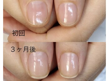 アイネイルズ(Ai nails)/形改善【ネイルケアコース】