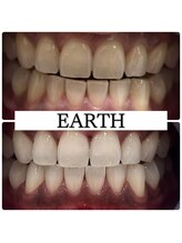 アース(EARTH)/【ビフォーアフター】美白