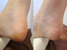 ひび割れ,ガサガサ踵の角質をツルツルスベスベに♪サンダル準備!