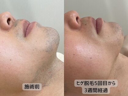 みんなのLED脱毛の写真
