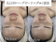 ラ ミュエル(La miel)/結果重視！韓国ILLONハーブ