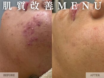 レヴェリー 心斎橋店(REVERIE)/‐ ハーブピーリングB&A ‐