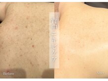 シューラディアント(ShuRadiant)/背中ケア/ニキビケア/くすみケア