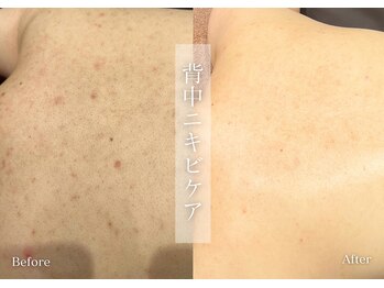 シューラディアント(ShuRadiant)/背中ケア/ニキビケア/くすみケア