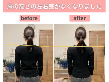 クオリア整体院 八王子(Cuoria整体院)/肩の高さの左右差が改善