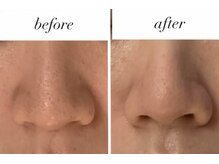 モテ肌 小顔コルギサロン カムトゥルー(come true)/毛穴洗浄／毛穴ケア