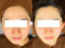 【まるで塗る針/美白効果◎】高濃度グルタチオン導入で韓国女優のような透明感♪白玉フェイシャル￥7980