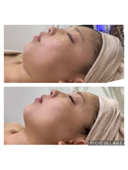 クリスタル(CRYSTAL)/肌質改善 小顔マシン使用