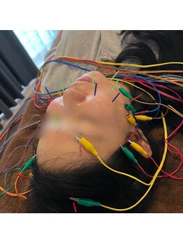 マル(malu)/美容鍼