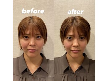 西宮しおりビューティーサロン(西宮しおりbeauty salon)/美容鍼 before(左)→after(右)3