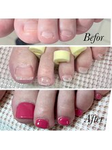 リミズネイルビューティー 名駅店(RimisNailxbeauty)/【美爪育成】《フット》深爪改善