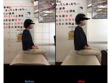 チャチャエイム整骨院 鍼灸院/猫背矯正ビフォーアフター