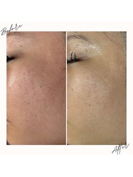 イチロクイチハチ(1618)/1度で赤みが落ち着きます