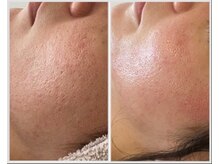 美しぐれ 溝の口店/【2ヶ月】プラズマ/ピーリング