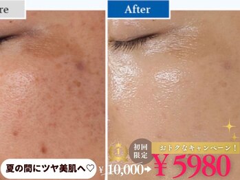 ミラ 中央林間(mira)の写真/【夏の紫外線/美白シミケア】最新ダクトピール＋黄色LED