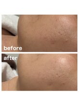 ミレボ 川内店(Me.rebo)/ララピール【 全顔＋首 】