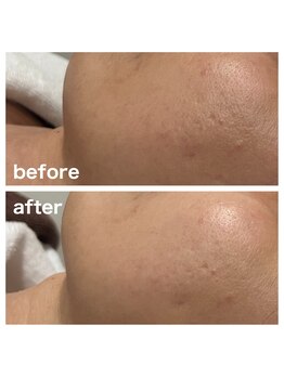 ミレボ 川内店(Me.rebo)/ララピール【 全顔+首 】