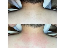 レーザーでは対応できない硬毛化してしまったけも脱毛可能です★