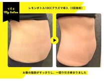 イエス マイサロン(yes My Salon)/レモンボトル施術例