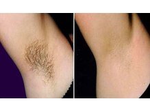 【脱毛】脱毛していたけど抜けなかった方がスルスル抜けていく♪